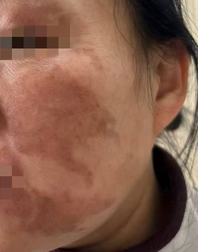 杭州41歲女子輕信美容院“快速祛斑”，結果變“花貓臉”！