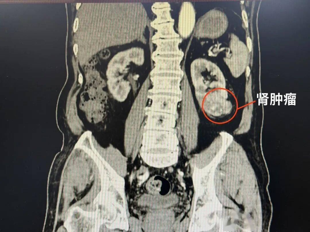 大德術說 | 89歲患腎癌，中西醫結合讓高齡患者快速康復