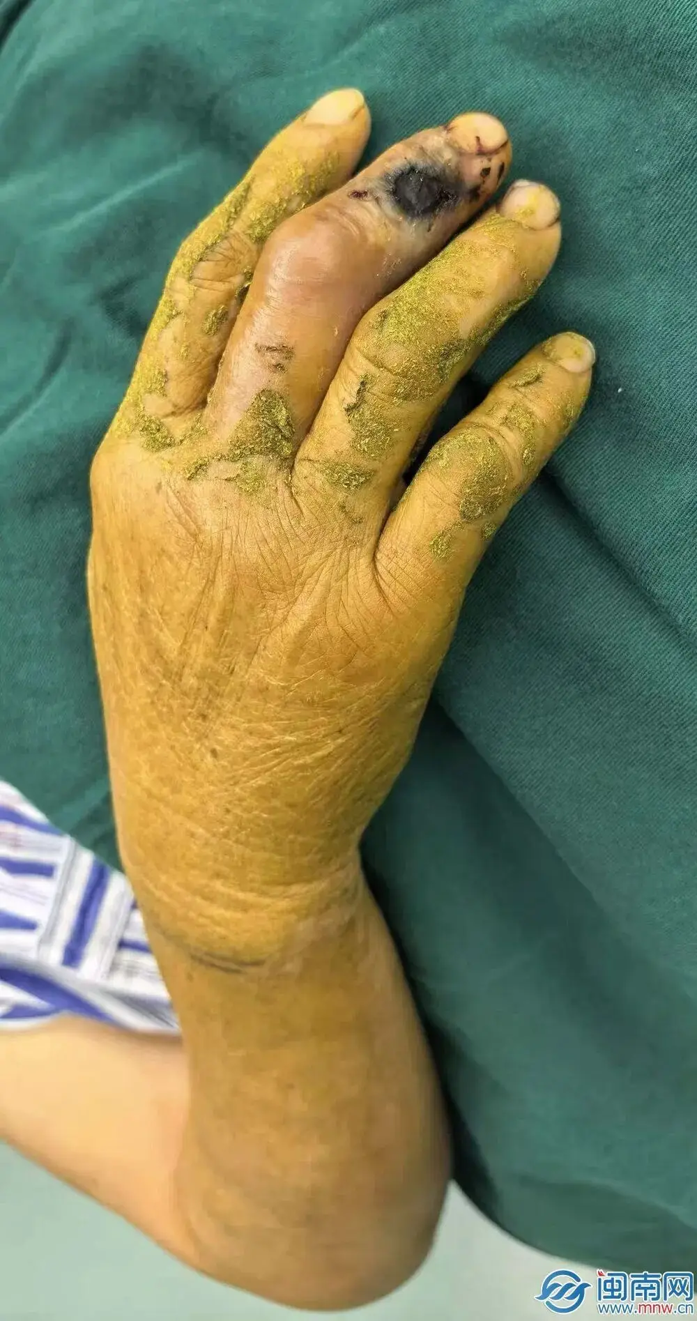 硬核自救！泉州53歲阿姨菜地被蛇咬，徒手活捉2米長眼鏡蛇……醫生提醒