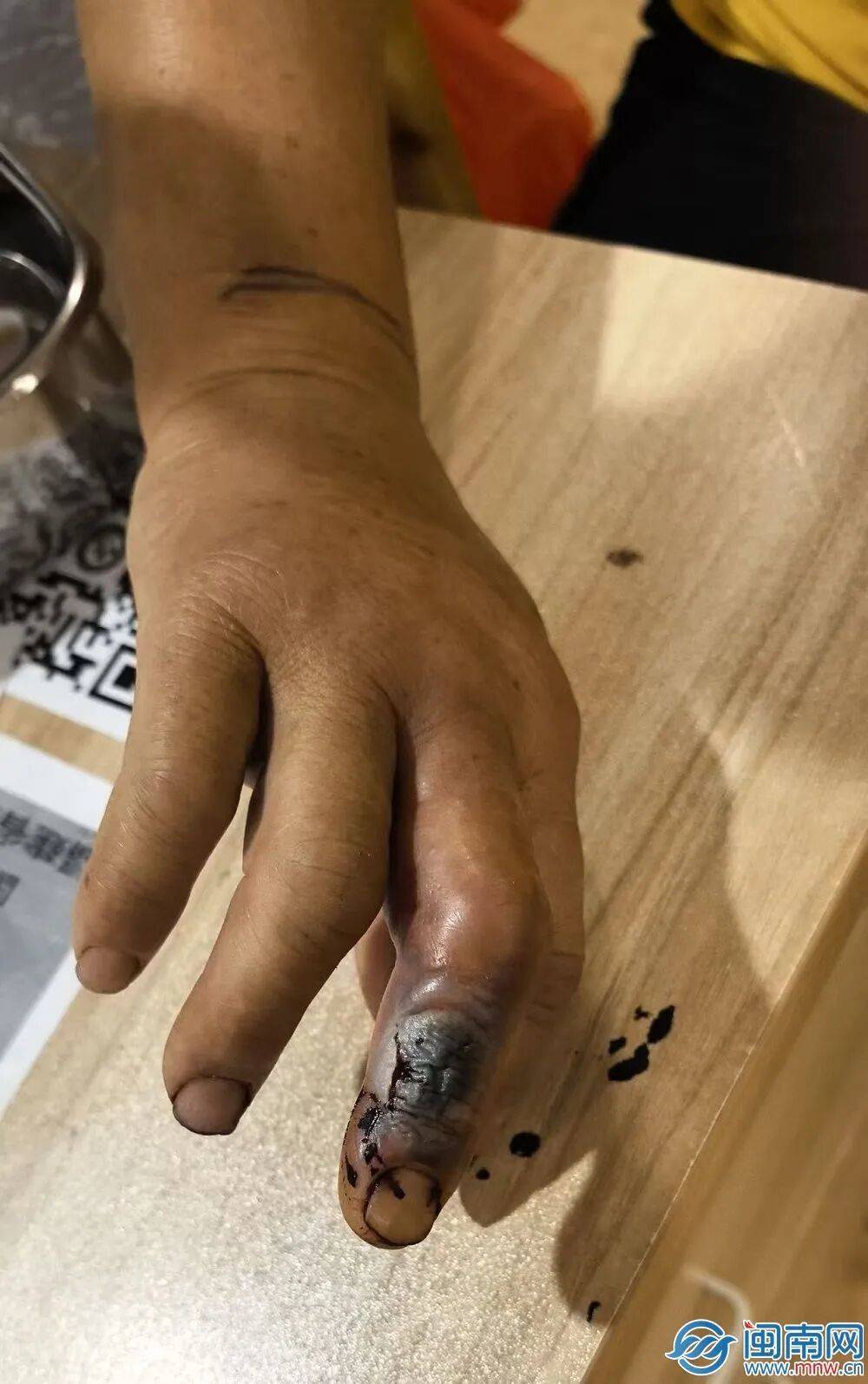 硬核自救！泉州53歲阿姨菜地被蛇咬，徒手活捉2米長眼鏡蛇……醫生提醒