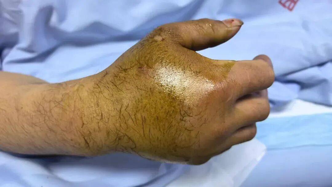 驚險自救！53歲阿姨被眼鏡蛇咬傷，徒手活捉2米毒蛇帶到醫院……