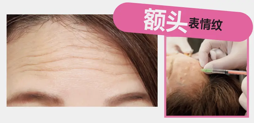 醫療美容 | 表情紋、眼周紋、法令紋，針對性改善！