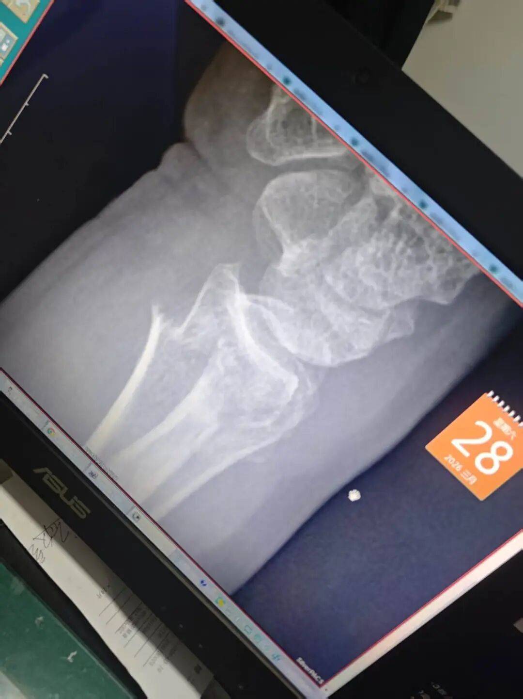 揚州一大型犬與柴犬打鬧，撲倒老人致手腕骨折，大型犬主人：正走法律程式，不會拒賠